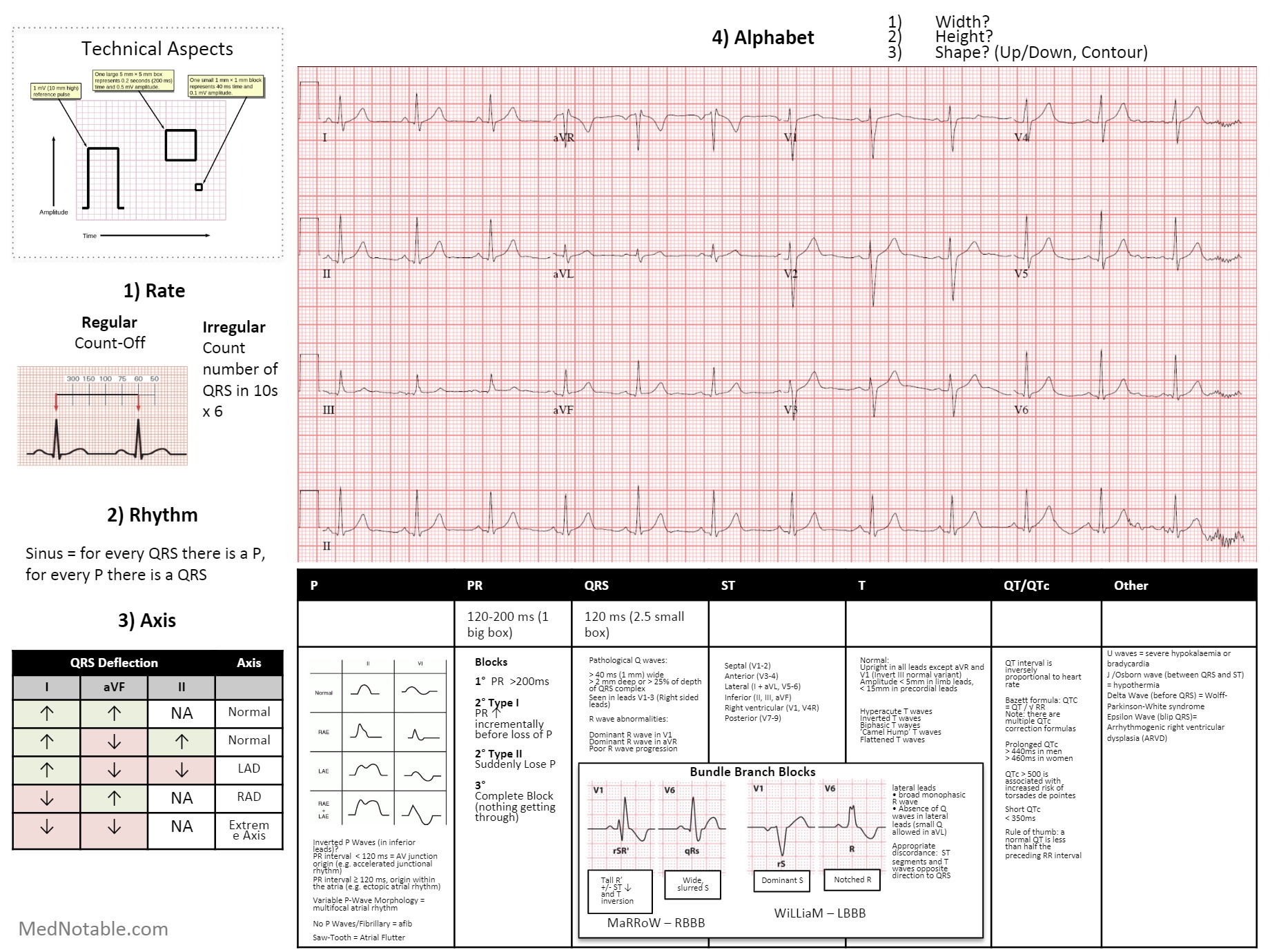 EKG Interpretation Cheat Sheet 1 Rate Regular GrepMed
